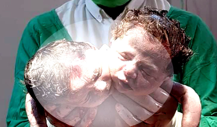 মাগুরায় জোড়ামাথার শিশুর জন্ম